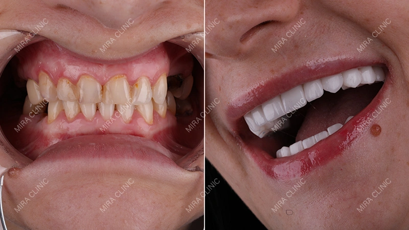 From Implants to a New Smile
